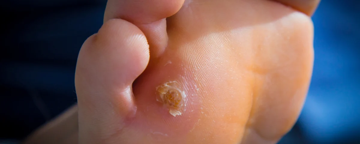 Tratamiento de verrugas plantares en Sanlúcar de Barrameda