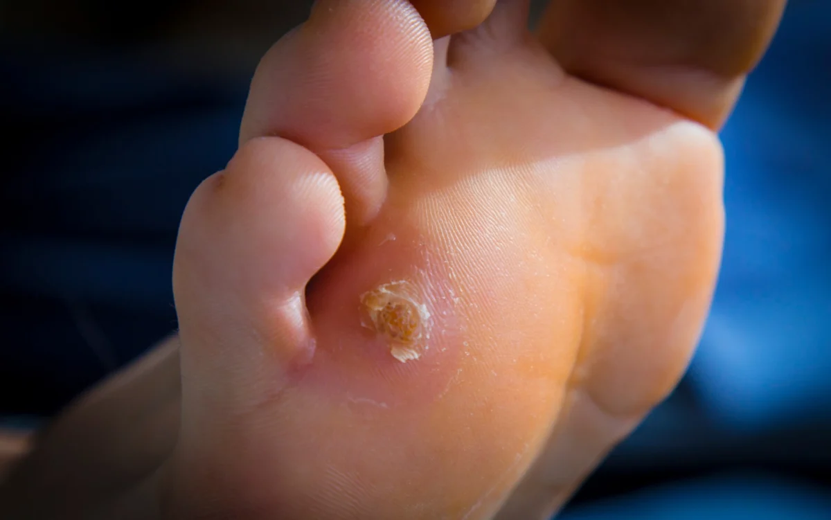 Tratamiento de verrugas plantares en Sanlúcar de Barrameda